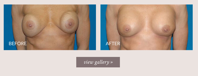 breast-revision-gallery.jpg