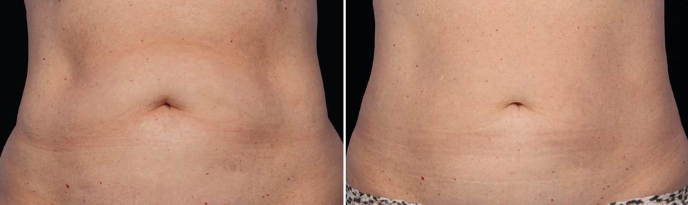 coolsculpting_before_after_03.jpg