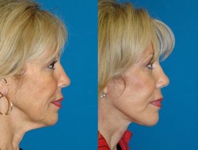What is the recovery like from a neck lift?