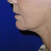 After neck liposuction, face and neck lift