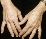 After treatment of brown age spots on hands