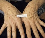Before treatment of brown age spots on hands