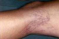 Before treatment of spider veins on the legs