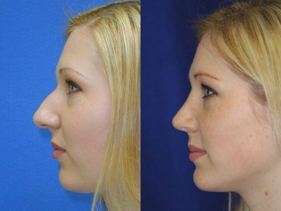 rhinoplasty hump nose surgery before primary plastic removal revision bump hooked tip nasal seattle dr procedure face results wide naficy