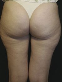 After Thermage treatment for cellulite