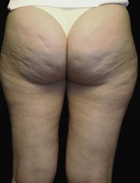 Before Thermage treatment for cellulite