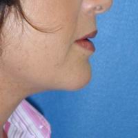 Neck Liposuction