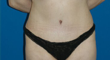 Tummy Tuck