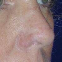 Nose Reconstruction