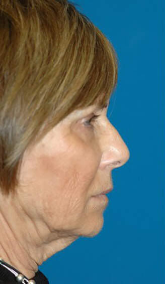 Neck Lift