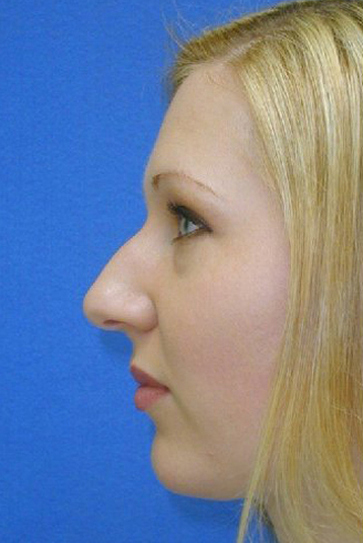 Primary Rhinoplasty