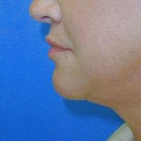 Chin Implants