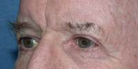 Eyelid Surgery