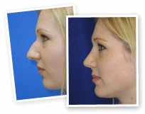 Image of Rhinoplasty Gallery Gallery