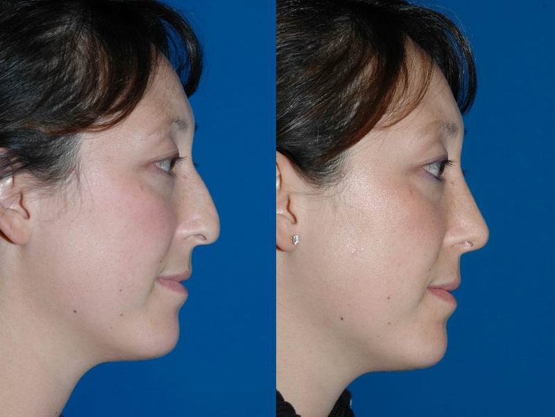 asian_rhinoplasty_04.jpg