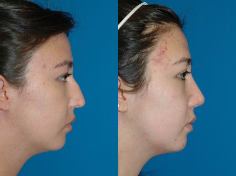 asian_rhinoplasty_06.jpg