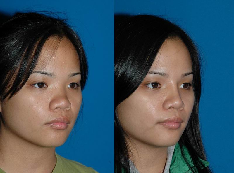 Asian Nose Bridge Surgery Telegraph