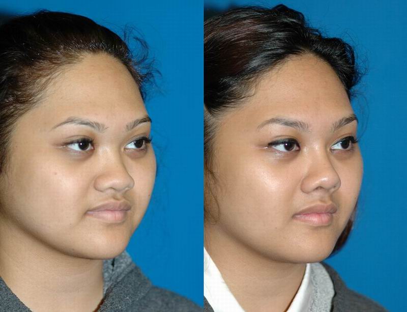 asian_rhinoplasty_25.jpg