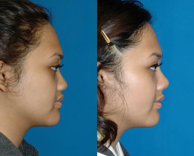 asian_rhinoplasty_26.jpg