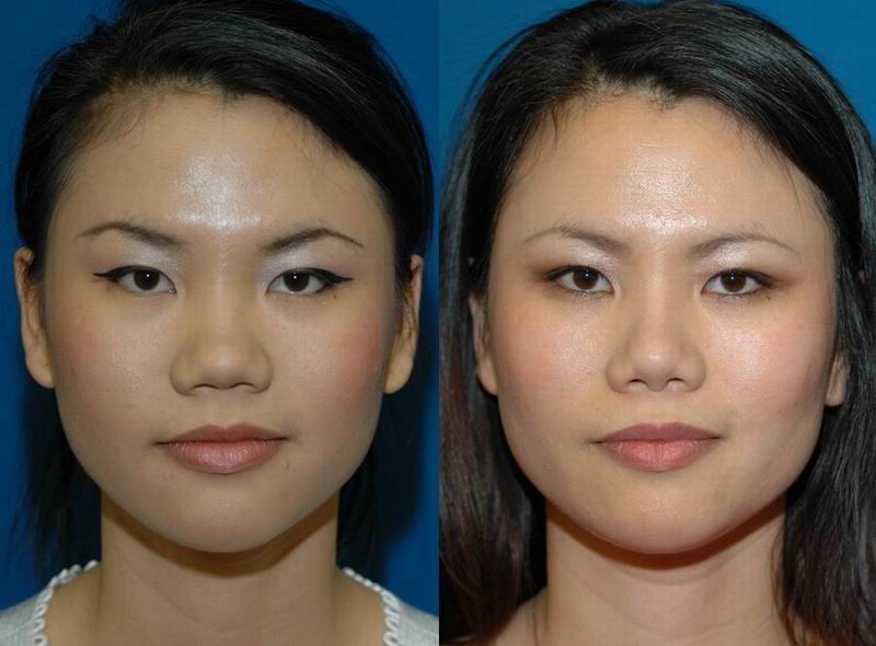 asian_rhinoplasty_27.jpg