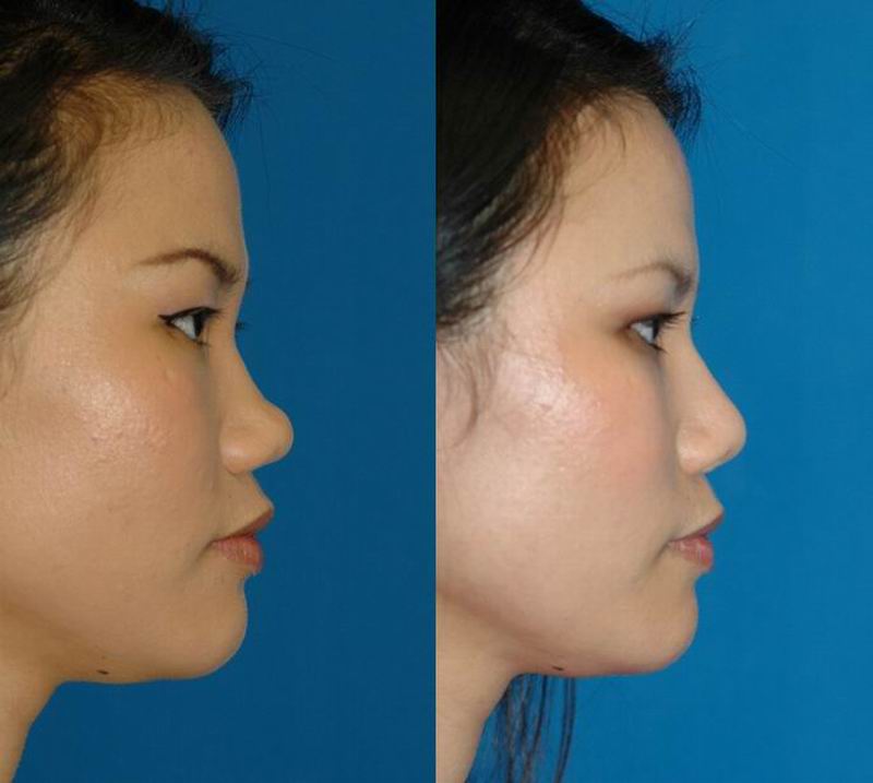 asian_rhinoplasty_28.jpg