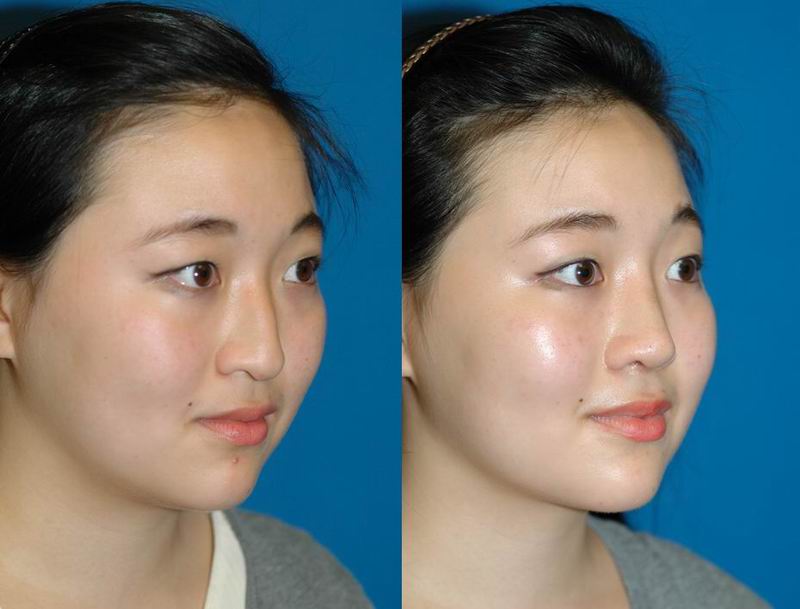 Asian Nose Bridge Surgery Telegraph