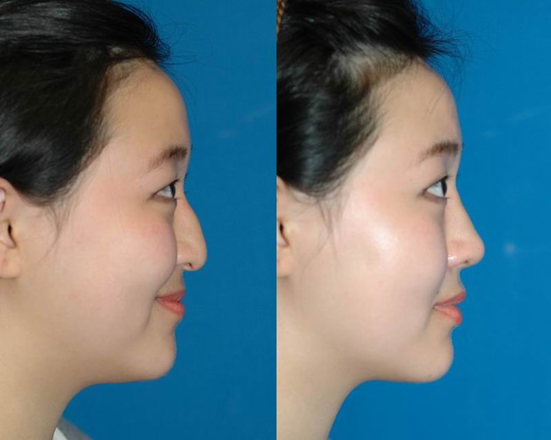 asian_rhinoplasty_34.jpg