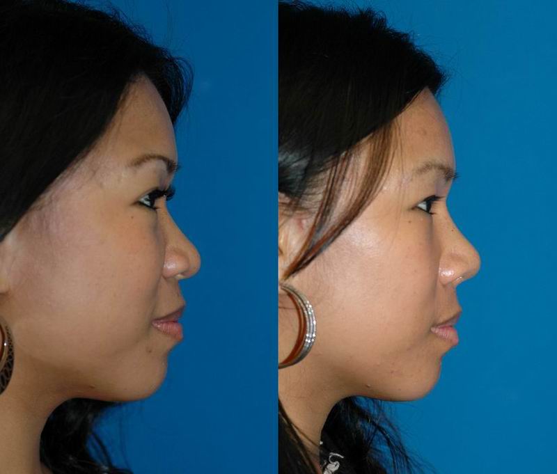 asian_rhinoplasty_38.jpg