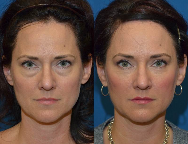 Bombe Kassette Lebenszeit blepharoplasty under eye bags Heftig Kalender ...