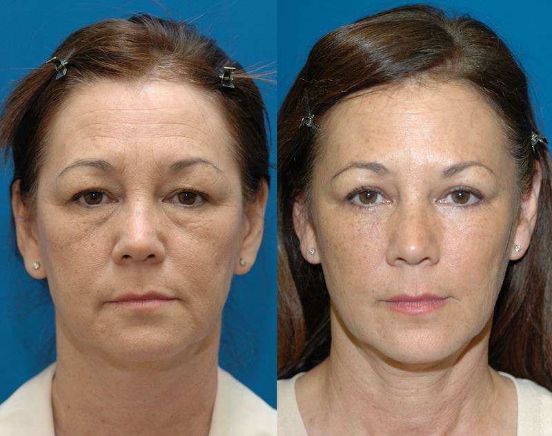 9 Tips to Speed Recovery After Eyelid Surgery (Blepharoplasty)