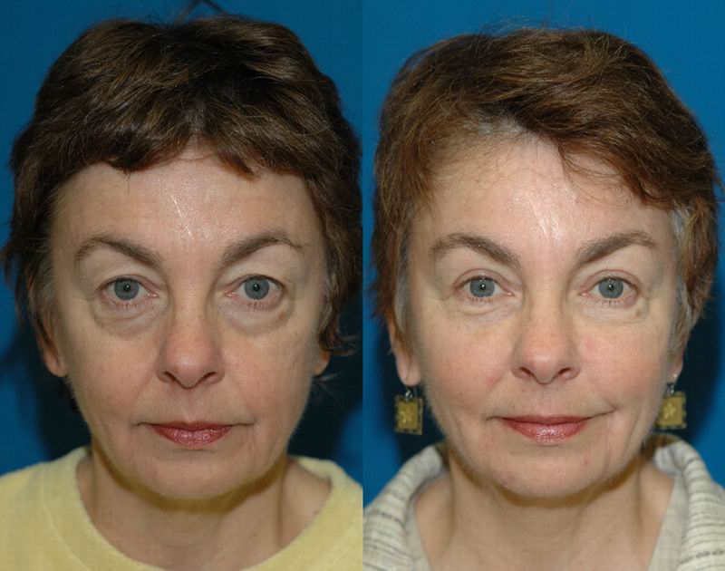 Eyelid Surgery - Sound Plastic Surgery, Cosmetic Plastic Surgery Clinic  Seattle