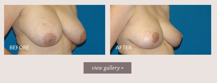 breast-reduction-gallery.jpg