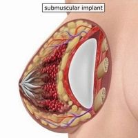 Breast implant placed under the muscle