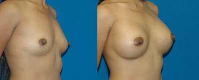 Breast augmentation with 375 cc silicone breast implants by Jourdan Gottlieb, MD