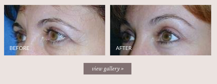 brow-lift-gallery.jpg