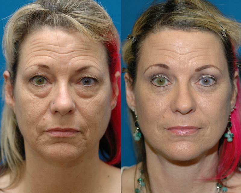 Facelift - Seattle Facial Plastic Surgeon- DrLamperti - Seattle, WA