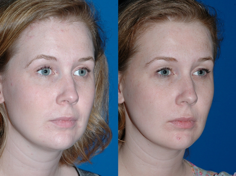 buccal02.jpg