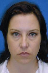 Before cheek lift, upper and lower blepharoplasty