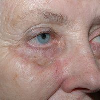 After cheek reconstruction by Sam Naficy, MD following removal of a lentigo maligna melanoma