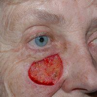 Before cheek reconstruction by Sam Naficy, MD following removal of a lentigo maligna melanoma
