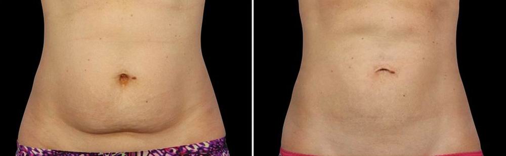 coolsculpting_before_after_01.jpg