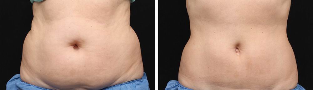 Image result for coolsculpting before and after