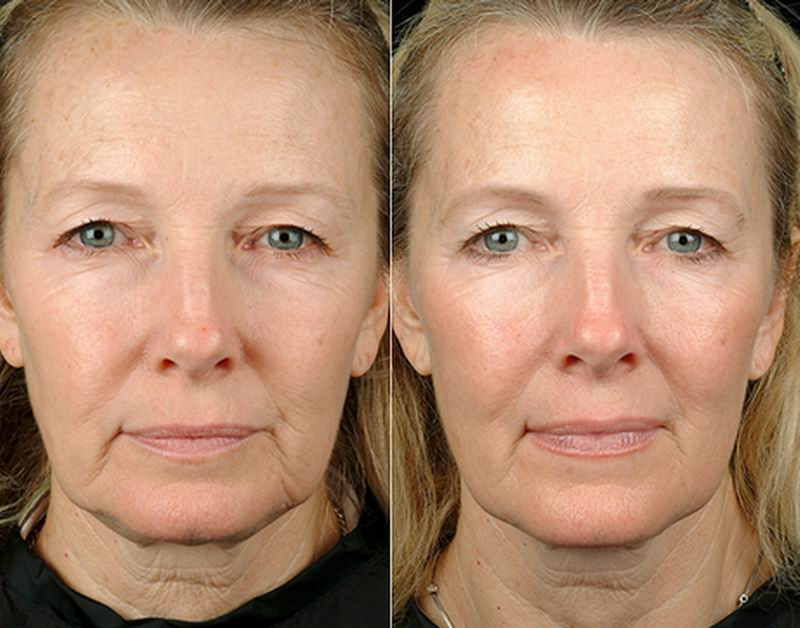 Thermage FLX for Face & Body | Thermage Skin Tightening | Bellevue Thermage