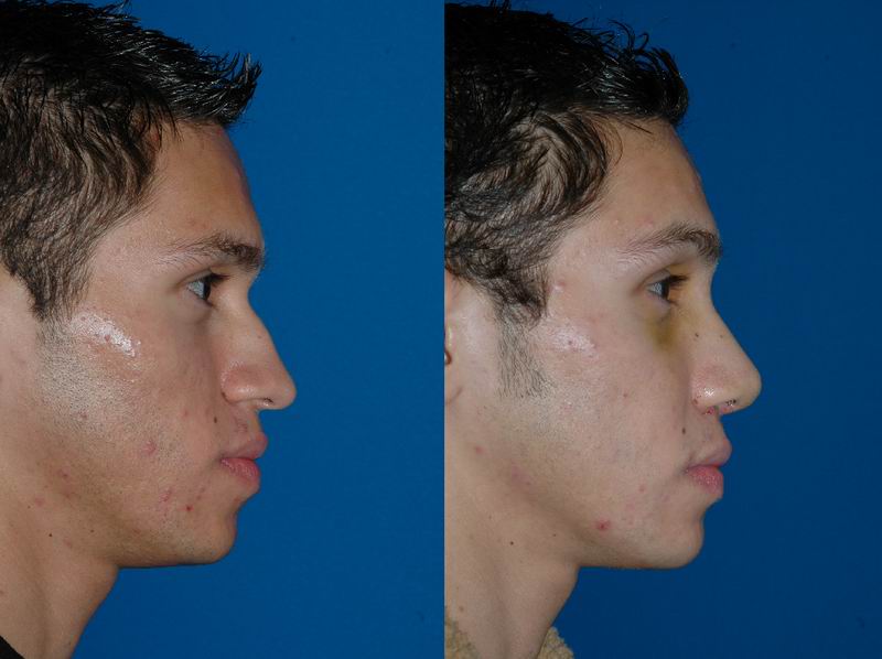 Nose Job Surgery in Seattle WA - Rhinoplasty For Men - YouTube