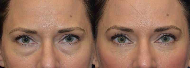 Natural Looking Eye Bag Surgery  By Leading Cosmetic Eye Surgeon