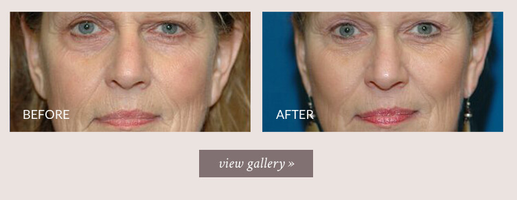face-lift-gallery2.jpg face-lift-gallery2.jpg