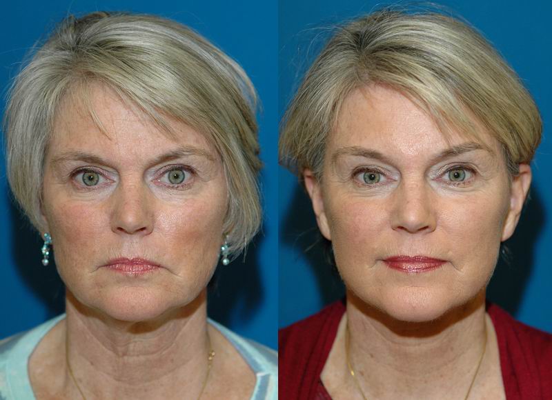 Face Lift Seattle - Face Lift Specialist