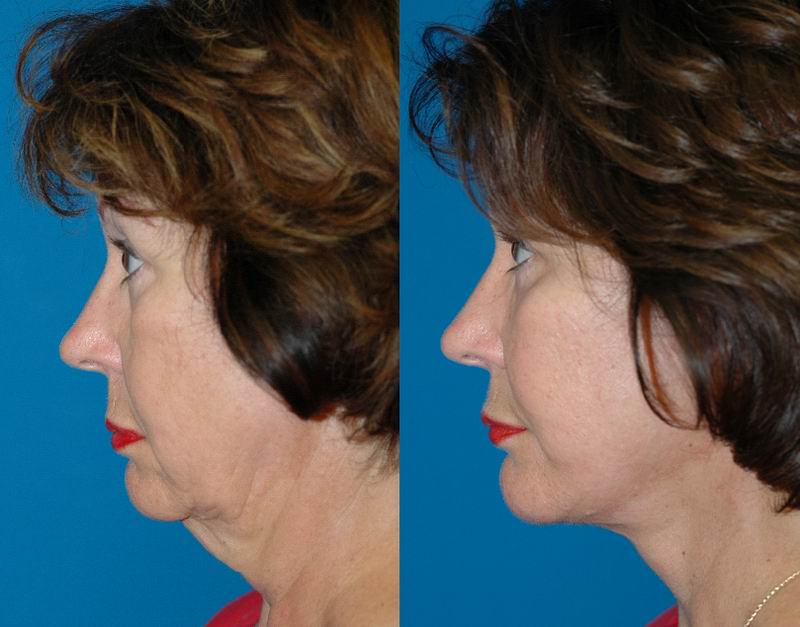 Over 50 Hair Cuts With A Turkey Neck 10 Women S Hairstyles To Hide That Double Chin Pictures Over 50 Hair Cuts With A Turkey Neck 10 Women S Hairstyles To Hide That Double Chin Pictures