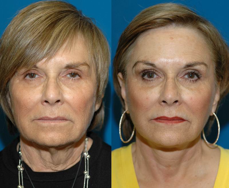 face_neck_fat093.jpg