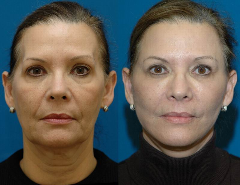 Facial Plastic Surgery Blog - Facial Rejuvenation Procedures